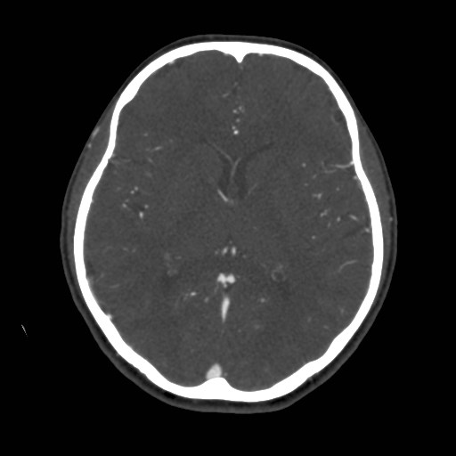 Cerebral venous sinus thrombosis (Radiopaedia 40619-43227 A 120).jpg