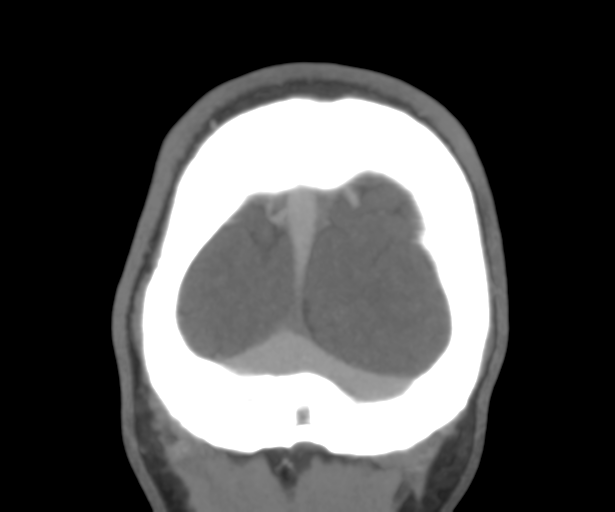 File:Cerebral venous thrombosis (Radiopaedia 38392-40467 Coronal CTA-Venogram 57).png