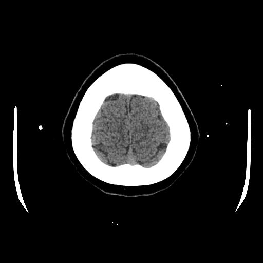 File:Cerebral venous thrombosis with venous hemorrhagic infarct (Radiopaedia 90354-107660 Axial non-contrast 46).jpg