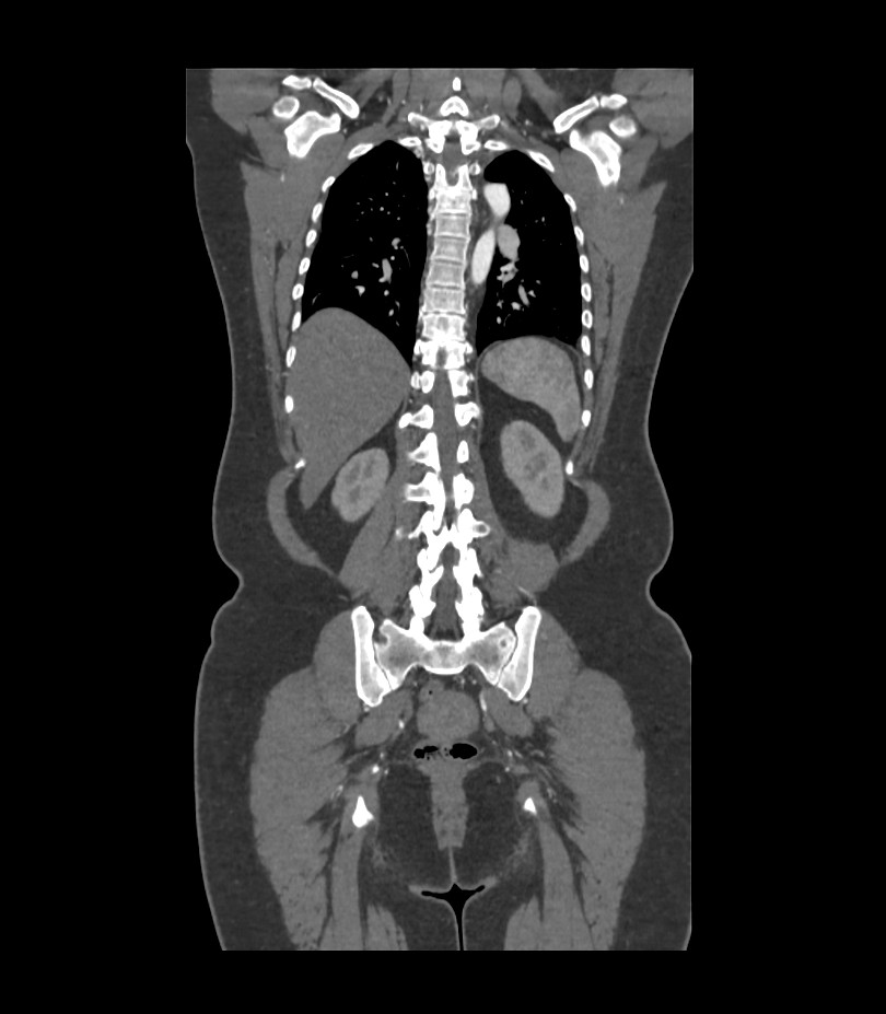 Cervical aortic arch with coarctation and aneurysms (Radiopaedia 44035-47552 C 12).jpg
