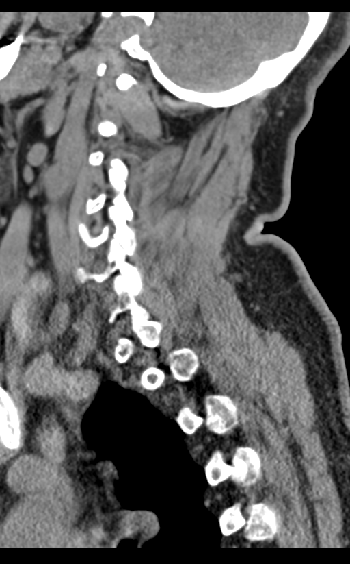 Cervical canal stenosis due to ossification of the posterior longitudinal ligament (Radiopaedia 47260-51823 D 59).png