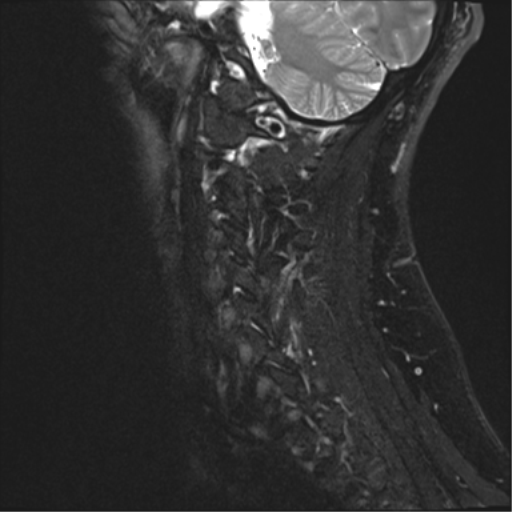 File:Cervical canal stenosis due to ossification of the posterior longitudinal ligament (Radiopaedia 47260-51824 Sagittal STIR 1).png
