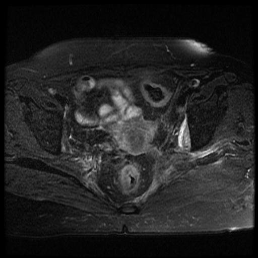 File:Cervical carcinoma (Radiopaedia 70924-81132 Axial T2 fat sat 7).jpg