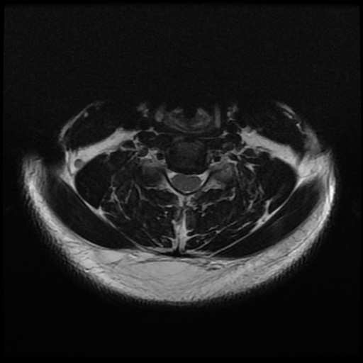 File:Cervical disc extrusion (Radiopaedia 59074-66364 Axial T2 9).jpg
