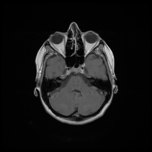 File:Cervical spondylodiscitis and calvarial hemangioma (Radiopaedia 64317-73103 Axial T1 C+ 23).jpg