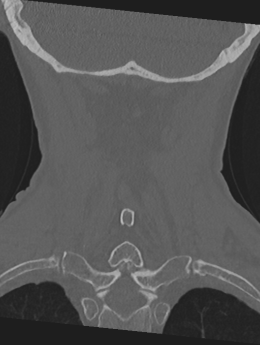 Cervical spondylolysis (Radiopaedia 49616-54811 Coronal bone window 46).png