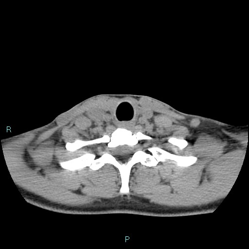 File:Cervical thymic cyst (Radiopaedia 88632-105335 Axial non-contrast 37).jpg