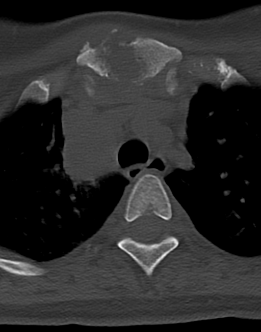 Cervical tuberculous spondylitis (Radiopaedia 39149-41365 Axial bone window 58).png