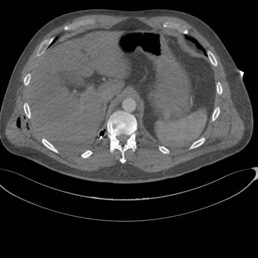 File:Chest multitrauma - aortic injury (Radiopaedia 34708-36147 A 279).png