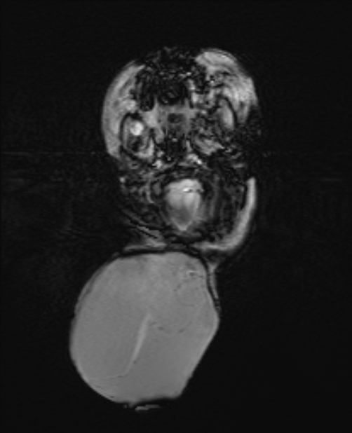 Chiari III malformation with occipital encephalocele (Radiopaedia 79446-92559 Axial SWI 21).jpg