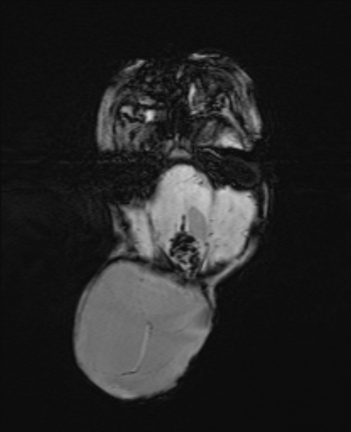 Chiari III malformation with occipital encephalocele (Radiopaedia 79446-92559 Axial SWI 26).jpg