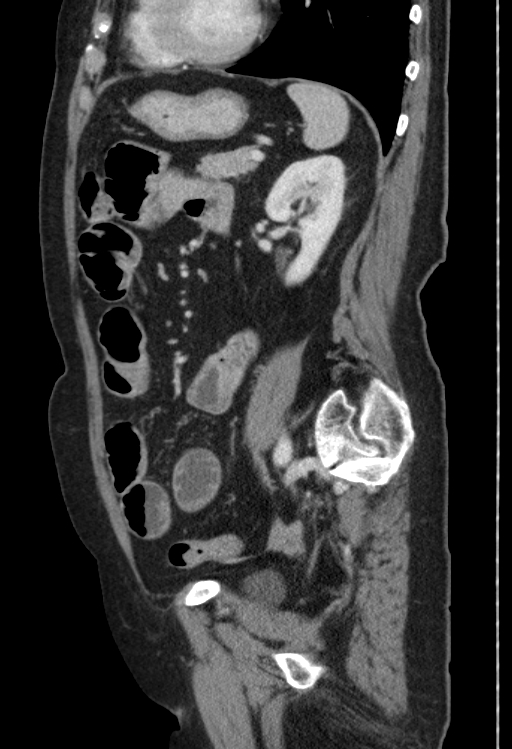 Cholecystoduodenal fistula due to calculous cholecystitis with gallstone migration (Radiopaedia 86875-103077 F 20).jpg