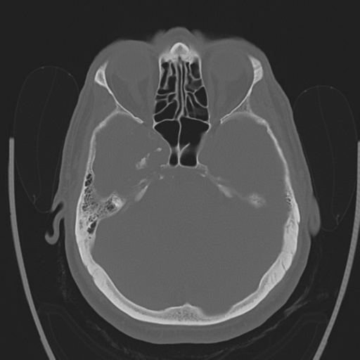 Chondrosarcoma of skull base- grade II (Radiopaedia 40948-43653 Axial bone window 14).png