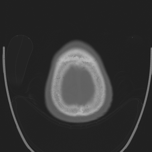 File:Chondrosarcoma of skull base- grade II (Radiopaedia 40948-43653 Axial bone window 47).png