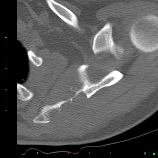File:Chondrosarcoma of the scapula (Radiopaedia 30696-31399 Axial non-contrast 9).jpg