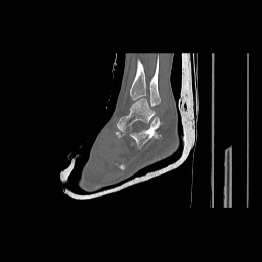 File:Chopart fracture (Radiopaedia 12386-12650 Sagittal bone window 2).jpg