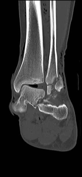 Chopart fracture (Radiopaedia 35347-36851 Coronal bone window 32).jpg