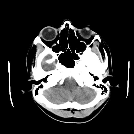 File:Choriocarcinoma of ovary with cerebral and pulmonary metastases (Radiopaedia 25983-26118 A 4).jpg