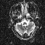 Choroid plexus xanthogranuloma - unilateral (Radiopaedia 85632-101393 Axial ADC 10).jpg