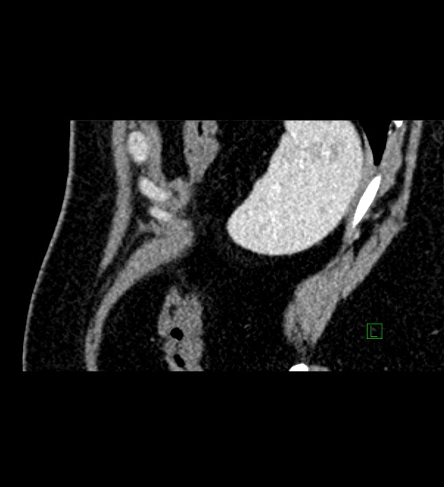 Chromophobe renal cell carcinoma (Radiopaedia 84286-99573 F 14).jpg