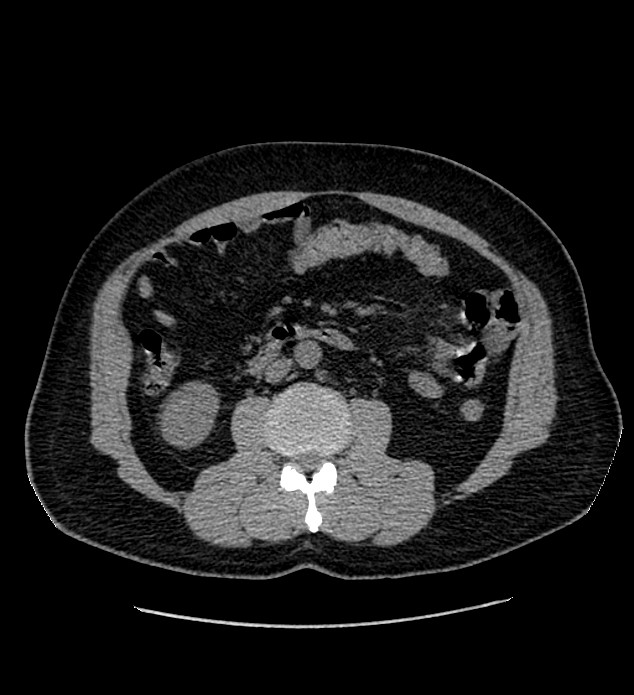 Chromophobe renal cell carcinoma (Radiopaedia 84337-99693 Axial non-contrast 70).jpg