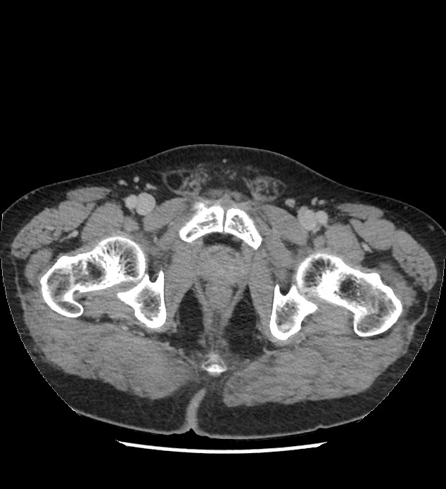 Chromophobe renal cell carcinoma (Radiopaedia 86879-103083 C 154).jpg