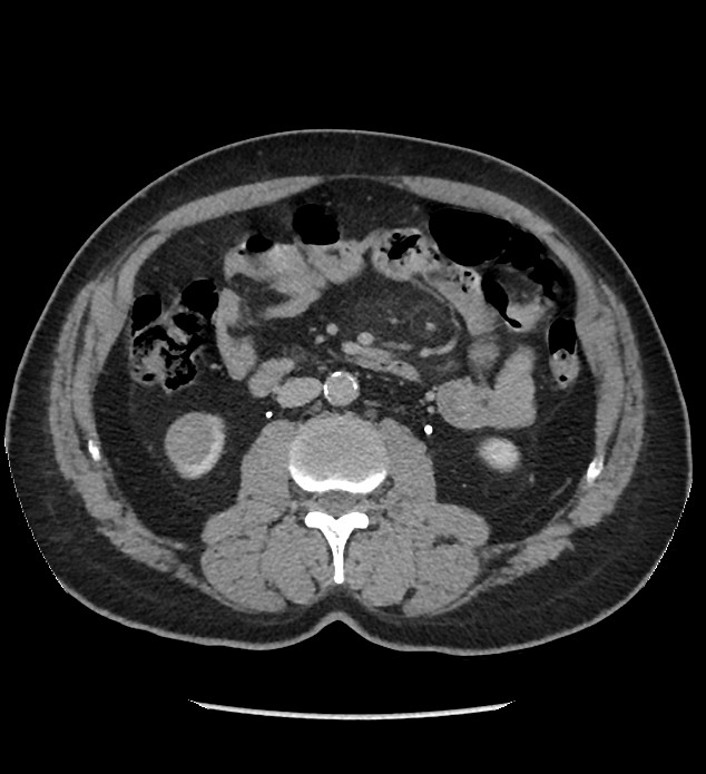 Chromophobe renal cell carcinoma (Radiopaedia 86879-103083 D 70).jpg