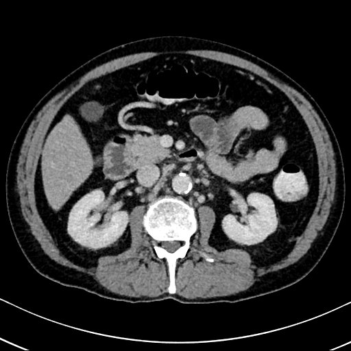 Chronic appendicitis complicated by appendicular abscess, pylephlebitis and liver abscess (Radiopaedia 54483-60700 B 67).jpg