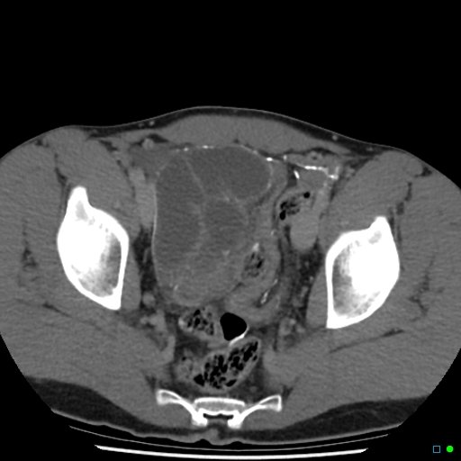 File:Chronic barium peritonitis and small bowel obstruction (Radiopaedia 29151-29548 D 14).jpg