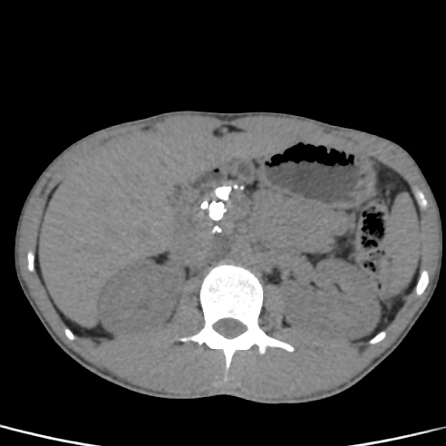File:Chronic calcific pancreatitis (Radiopaedia 56280-62953 Axial non-contrast 16).jpg