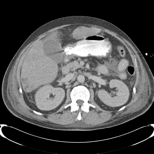 Chronic diverticulitis complicated by hepatic abscess and portal vein thrombosis (Radiopaedia 30301-30938 A 39).jpg