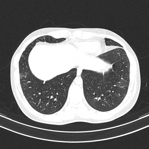 Chronic eosinophilic pneumonia (Radiopaedia 39331-41587 Axial lung window 44).png