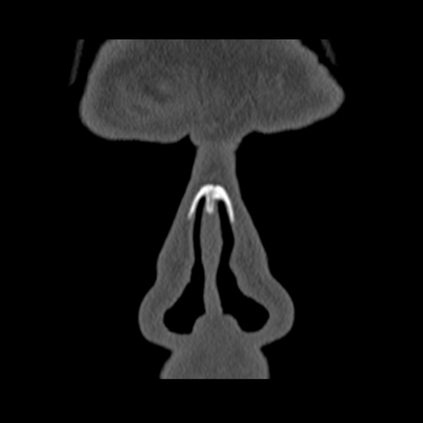 Chronic maxillary sinusitis (Radiopaedia 27879-28116 Coronal bone window 2).jpg