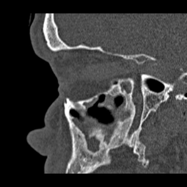 Chronic maxillary sinusitis (Radiopaedia 27879-28116 Sagittal bone window 39).jpg
