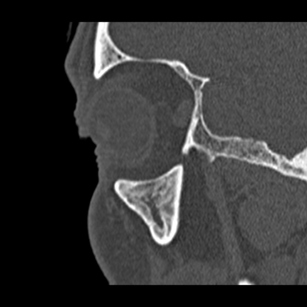 Chronic maxillary sinusitis (Radiopaedia 27879-28116 Sagittal bone window 51).jpg