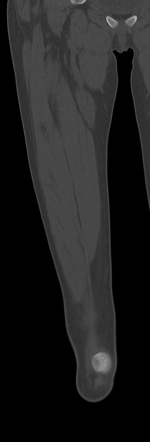 Chronic ostemyelitis of the femur with long sinus tract (Radiopaedia 74947-85982 Coronal bone window 25).jpg
