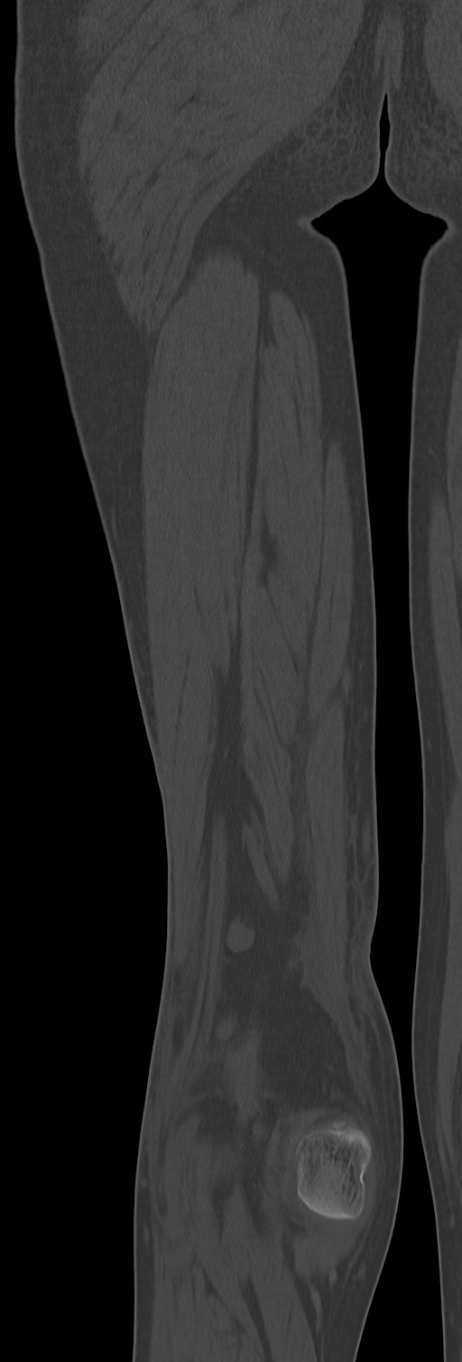 Chronic ostemyelitis of the femur with long sinus tract (Radiopaedia 74947-85982 Coronal bone window 62).jpg
