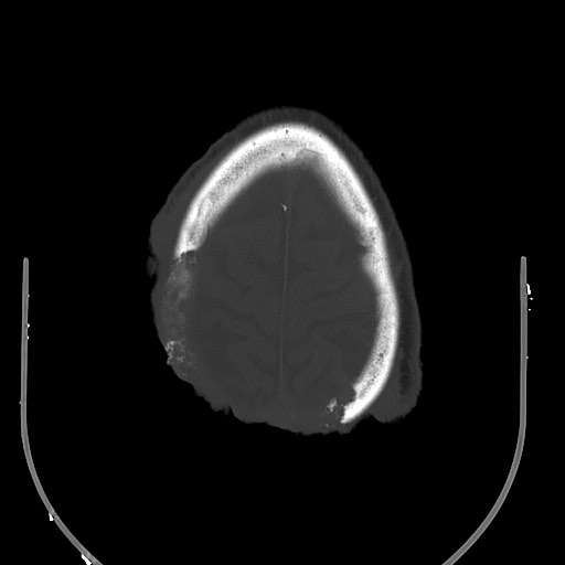 Chronic osteomyelitis - calvarial (severe) (Radiopaedia 69668-79616 Axial bone window 65).jpg
