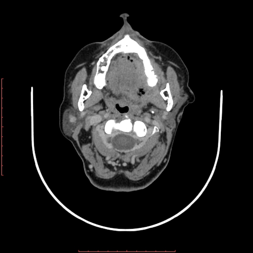 File:Chronic osteomyelitis - maxilla (Radiopaedia 23783-23927 B 59).jpg