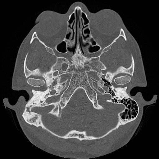 File:Chronic otomastoiditis (Radiopaedia 27138-27309 Axial bone window 18).jpg