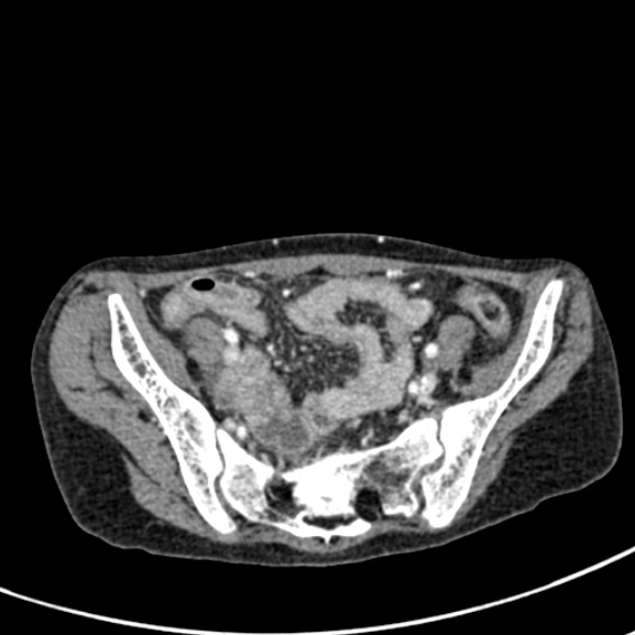 Chronic pancreatitis (Radiopaedia 55405-61846 A 83).jpg
