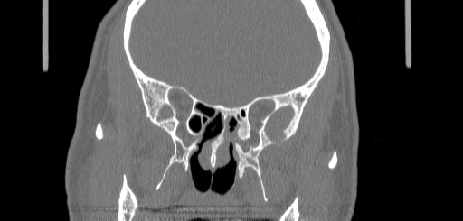 Chronic sphenoidal sinusitis (Radiopaedia 62030-70122 Coronal bone window 97).jpg