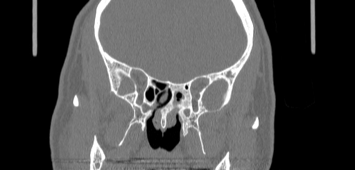 Chronic sphenoidal sinusitis (Radiopaedia 62030-70122 Coronal bone window 99).jpg