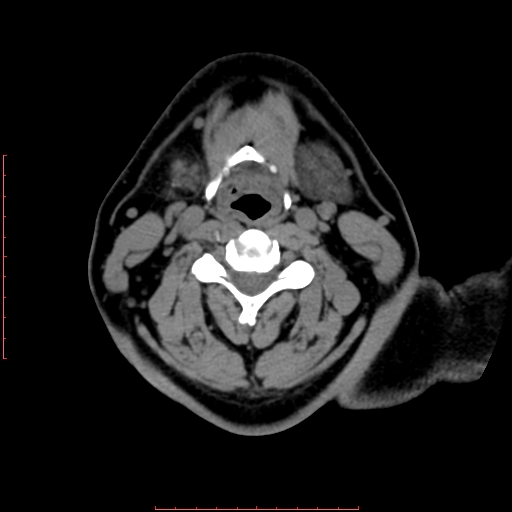Chronic submandibular sialolithiasis (Radiopaedia 69817-79814 Axial non-contrast 138).jpg