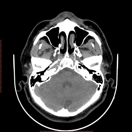 Chronic submandibular sialolithiasis (Radiopaedia 69817-79814 Axial non-contrast 6).jpg