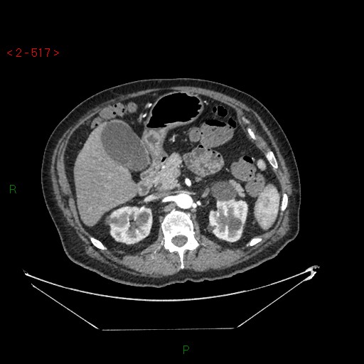 Circumaortic left renal vein and doubled left renal arteries (Radiopaedia 52268-58158 A 53).jpg