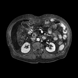 File:Cirrhosis and hepatocellular carcinoma in the setting of hemochromatosis (Radiopaedia 75394-86594 Axial T1 C+ fat sat 192).jpg