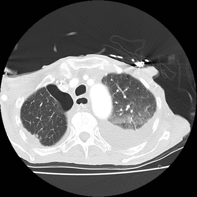 Clagett thoracotomy with bronchopleural fistula (Radiopaedia 29192-29587 Axial lung window 11).jpg