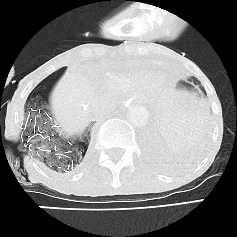 Clagett thoracotomy with bronchopleural fistula (Radiopaedia 29192-29587 Axial lung window 44).jpg