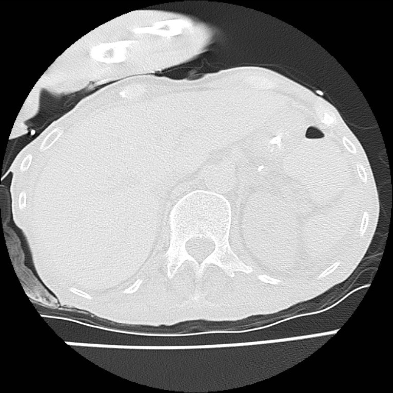 Clagett thoracotomy with bronchopleural fistula (Radiopaedia 29192-29587 Axial lung window 52).jpg
